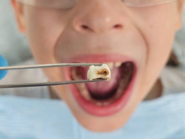 Best Emergency Tooth Extraction in East Niles, CA