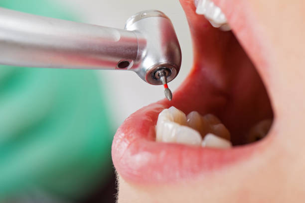 Best Walk-In Emergency Dentist in East Niles, CA